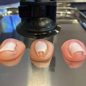 Trois modèles d’ongles pathologiques utilisés pendant les formations Pediform